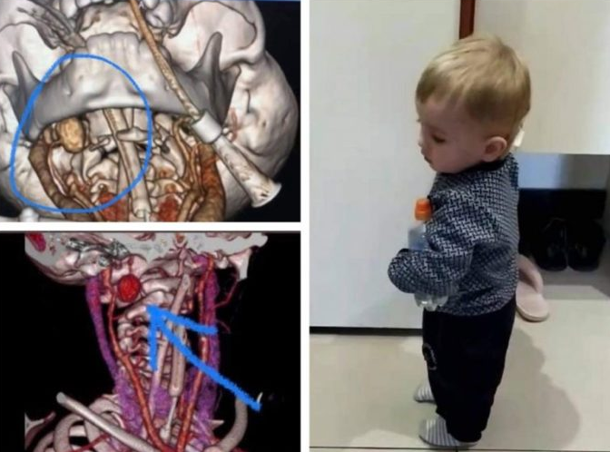 Кров із горла фонтаном і клінічна смерть: лікарі врятували хлопчика з Прикарпаття