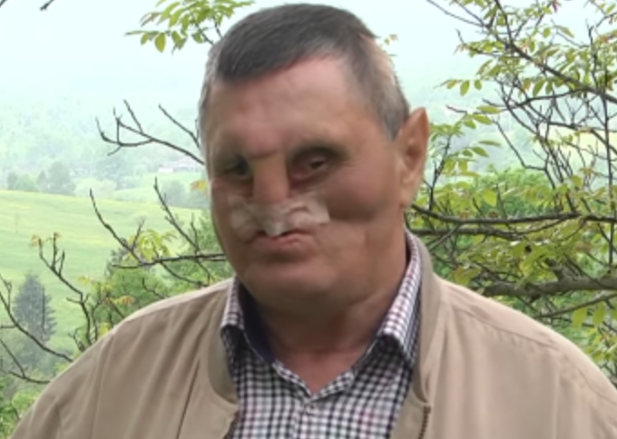 На Прикарпатті чоловік дивом вижив після зустрічі з ведмедицею. ВІДЕО