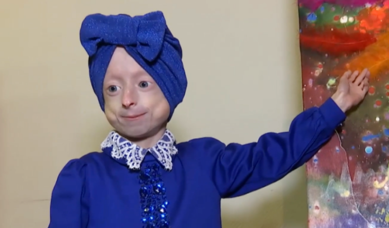 У Вінниці померла дівчинка з рідкісним синдромом передчасного старіння