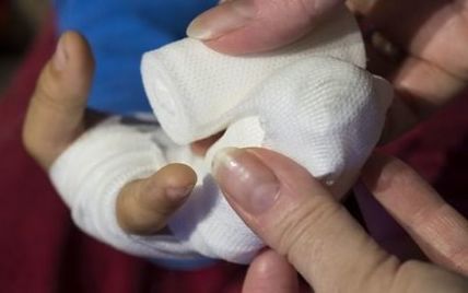 На Одещині в руках у підлітка вибухнув невідомий предмет, – ЗМІ