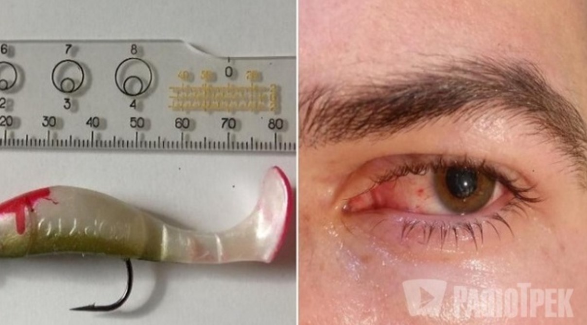 У Рівному з ока дитини дістали 80-міліметровий рибальський гачок (ФОТО)