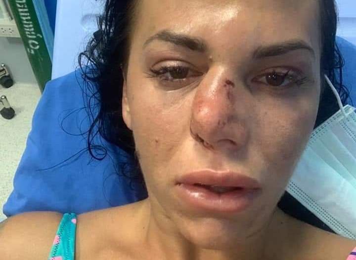 Розтрощений ніс та тріщина у черепі: за кордоном серйозно травмувалася молода тернополянка (фото)