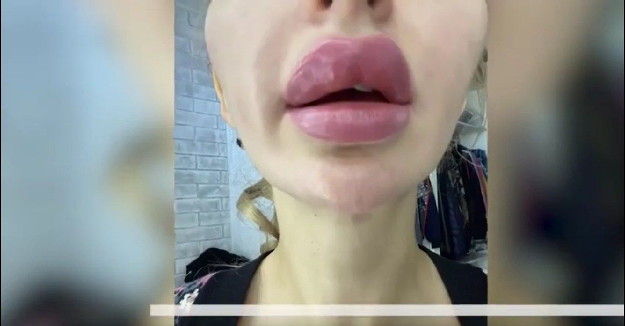 Збільшувала губи, а перекосило все обличчя: у Запоріжжі зростає кількість жертв краси, горе-косметолога розшукують