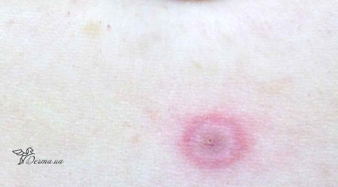 На Калущині зареєстрований другий випадок хвороби Лайма