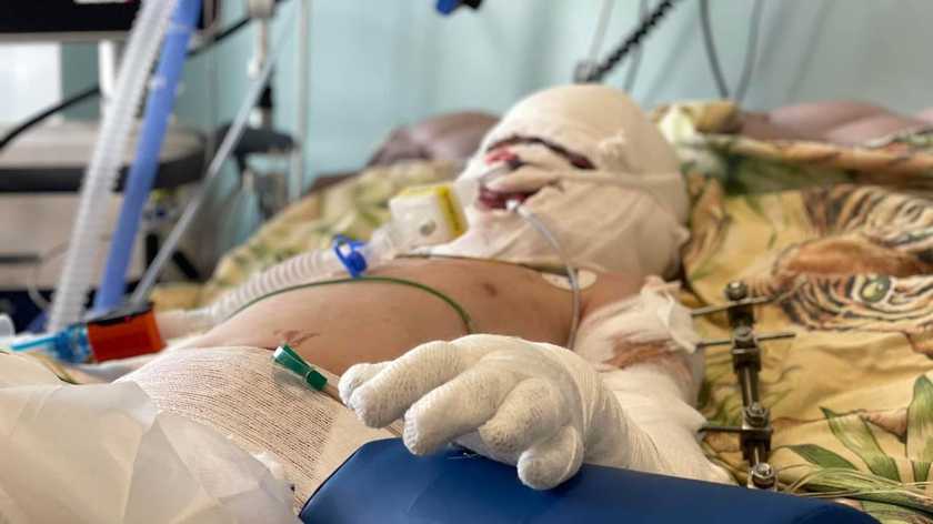 7-річного хлопчика, який постраждав внаслідок удару по Вінниці, чекає пересадка шкіри