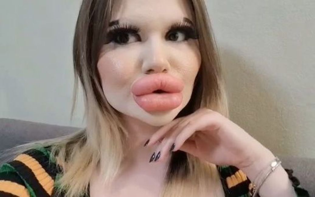 Жінка з найбільшими губами у світі вирішила змінити ще одну частину обличчя: який вона має вигляд