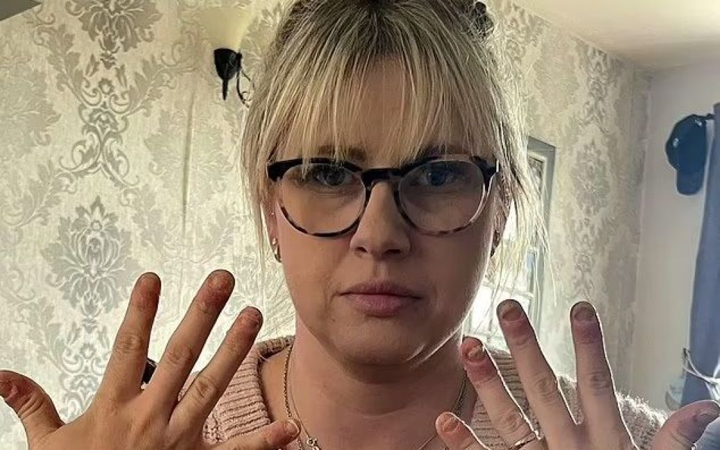 Сходила на манікюр: жінка шокувала жорсткою алергією на гель-лак – фото.